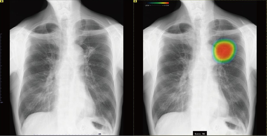 胸部X線画像病変検出ソフトウェアの画像